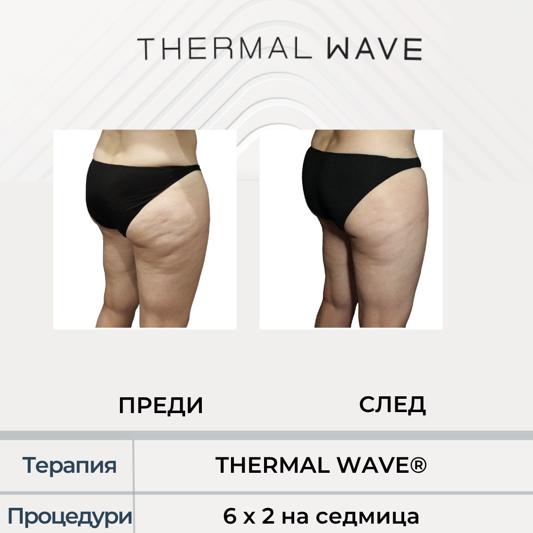 Бедра преди и след курс с THERMAL WAVE