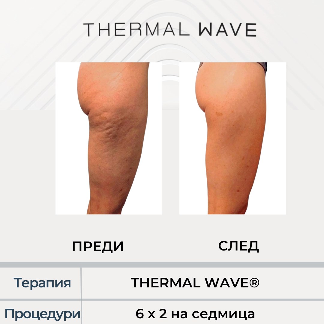 Бедра и прасци преди и след THERMAL WAVE