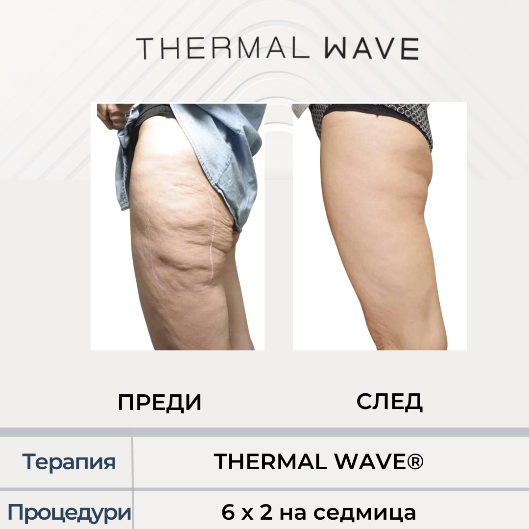 Бедра преди и след THERMAL WAVE