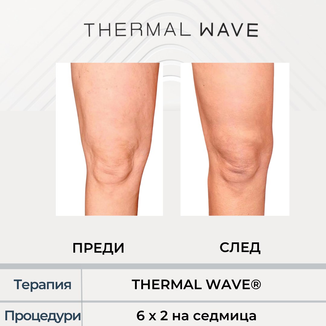 Бедра и колене преди и след THERMAL WAVE