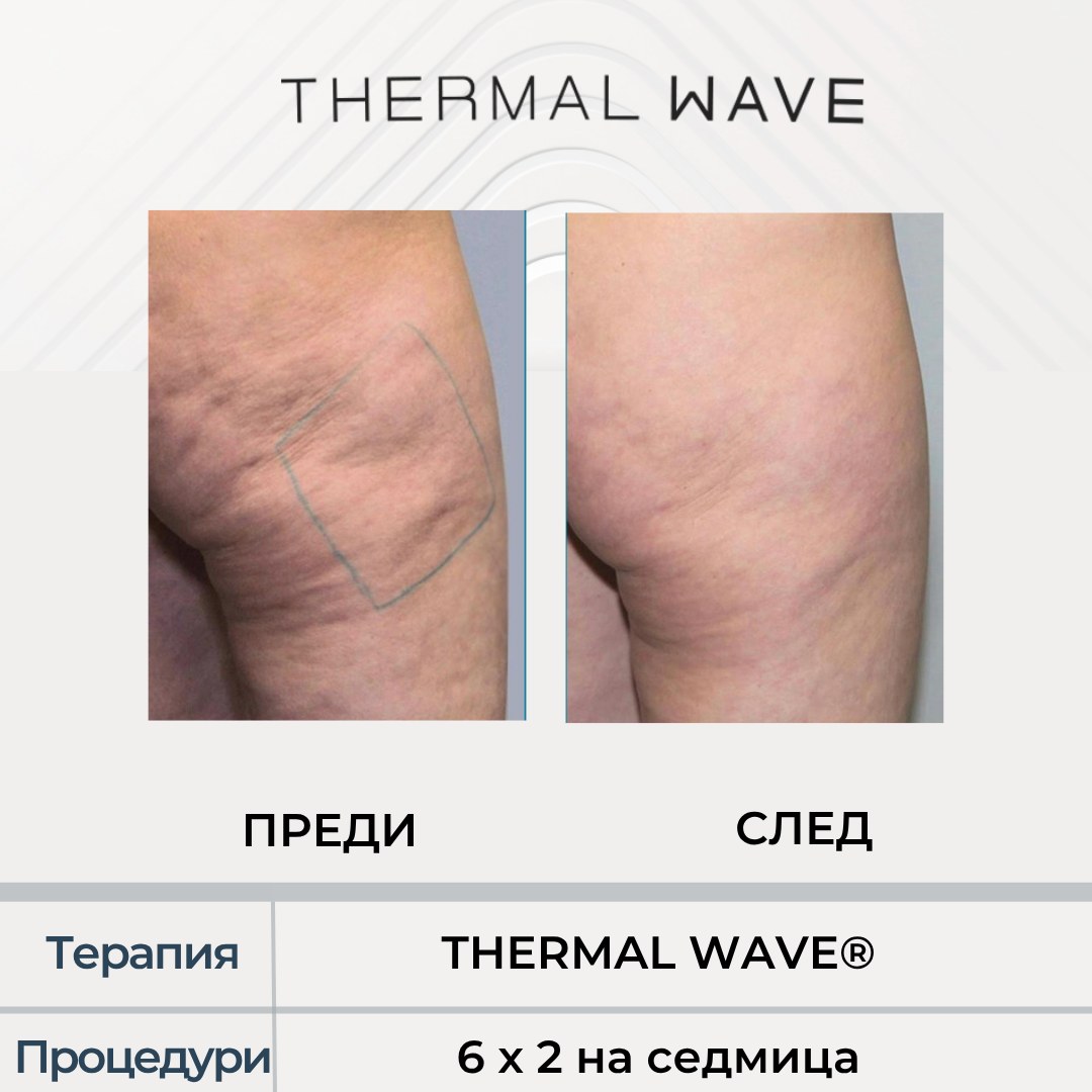 Седалище и бедро преди и след THERMAL WAVE