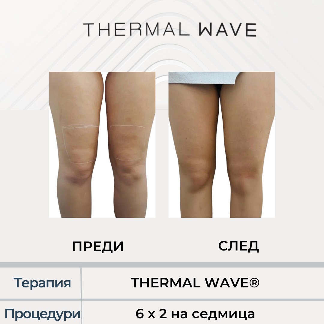 Бедра и колене преди и след THERMAL WAVE
